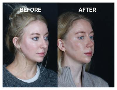 Revision Rhinoplasty Before & After Gallery - Patient 643963 - Image 1