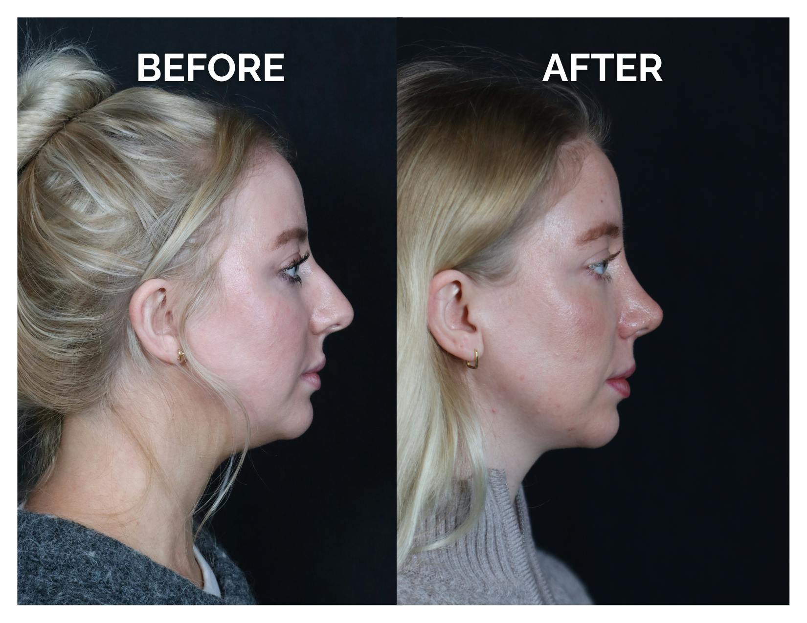 Revision Rhinoplasty Before & After Gallery - Patient 643963 - Image 3