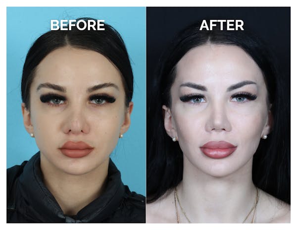 Revision Rhinoplasty Before & After Gallery - Patient 206134 - Image 1