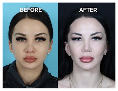 Revision Rhinoplasty Before & After Gallery - Patient 206134 - Image 1