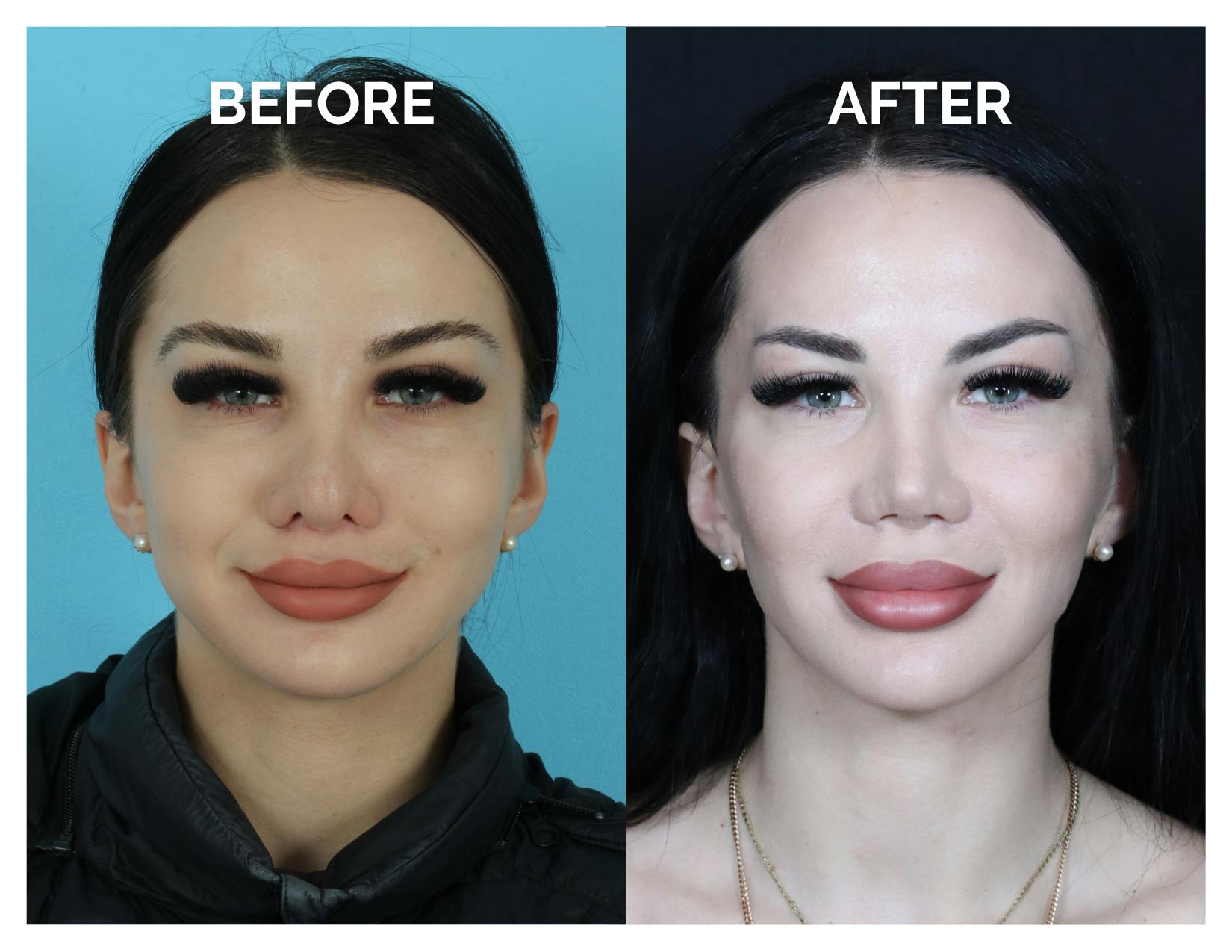 Revision Rhinoplasty Before & After Gallery - Patient 206134 - Image 4