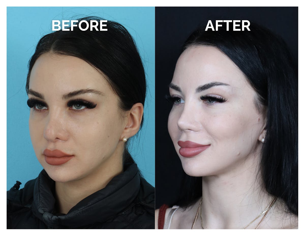 Revision Rhinoplasty Before & After Gallery - Patient 206134 - Image 3