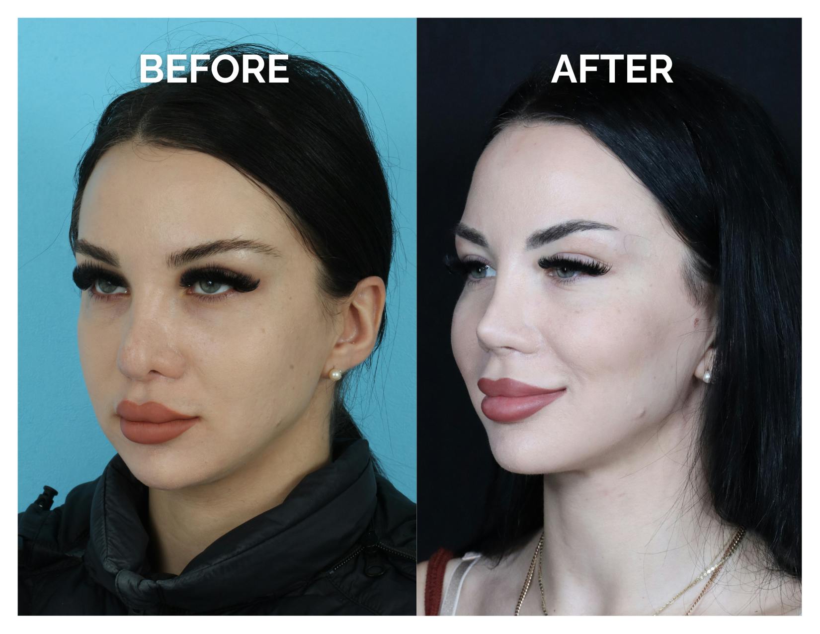 Revision Rhinoplasty Before & After Gallery - Patient 206134 - Image 3