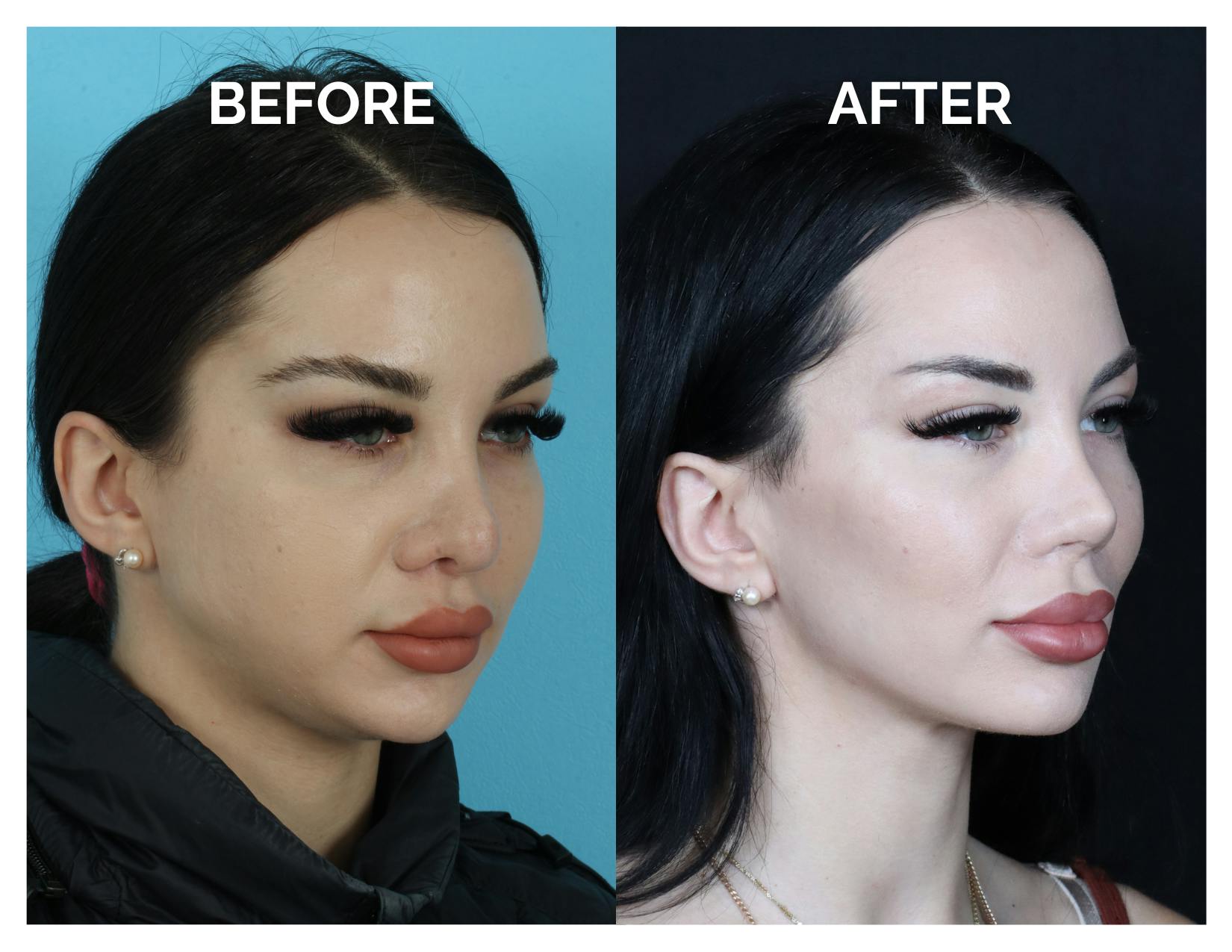 Revision Rhinoplasty Before & After Gallery - Patient 206134 - Image 2