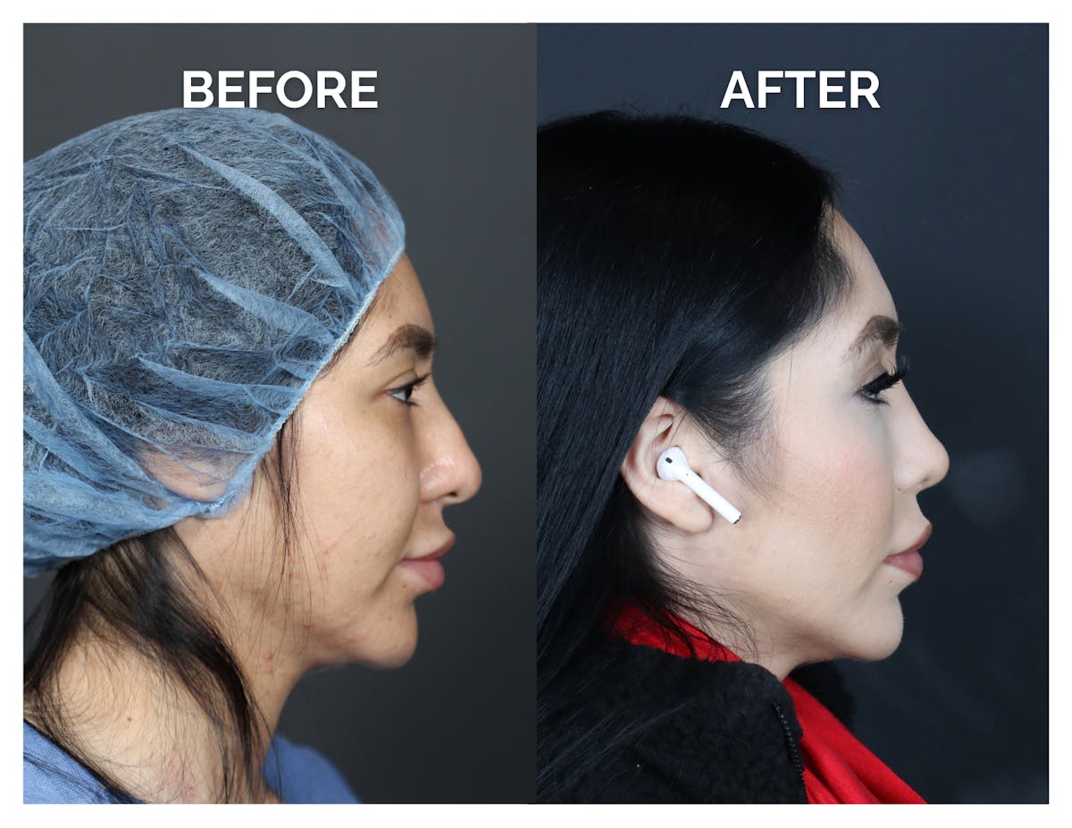 Revision Rhinoplasty Before & After Gallery - Patient 236004 - Image 2