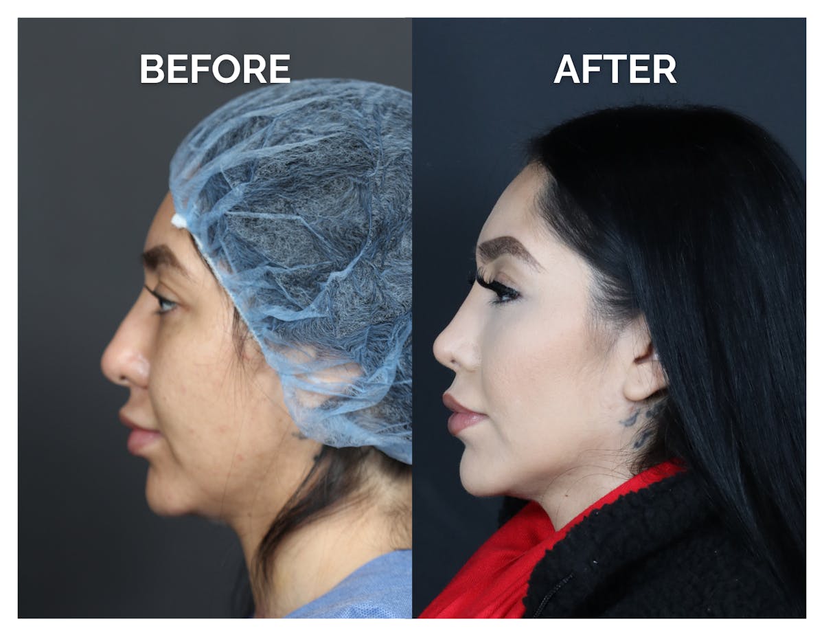 Revision Rhinoplasty Before & After Gallery - Patient 236004 - Image 3
