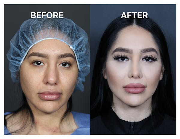 Revision Rhinoplasty Before & After Gallery - Patient 236004 - Image 1