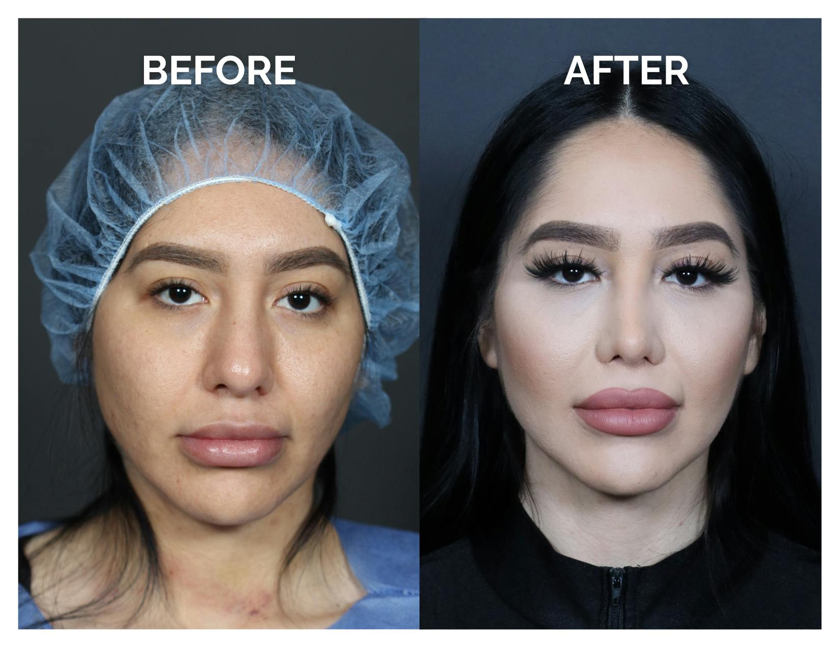 Revision Rhinoplasty Before & After Gallery - Patient 236004 - Image 1