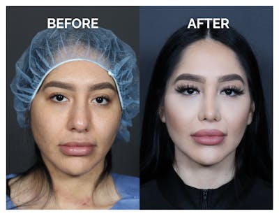 Revision Rhinoplasty Before & After Gallery - Patient 236004 - Image 1