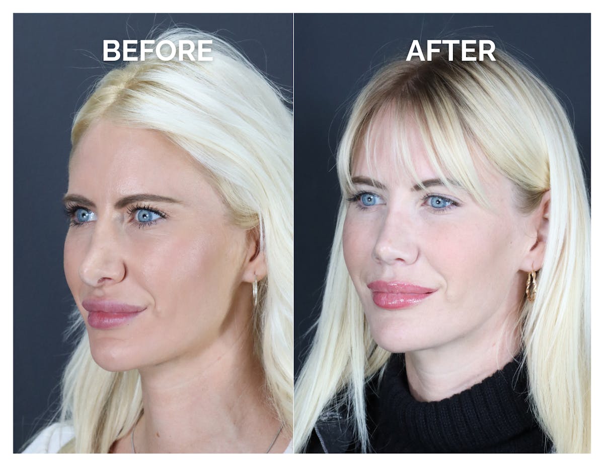 Revision Rhinoplasty Before & After Gallery - Patient 336468 - Image 3