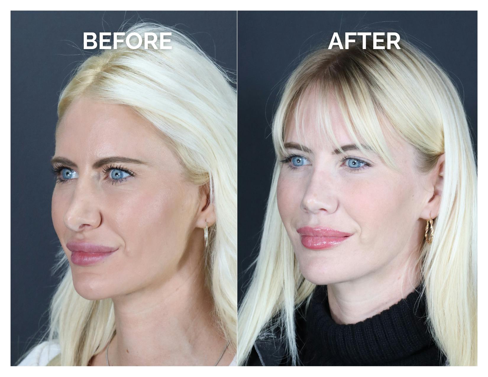 Revision Rhinoplasty Before & After Gallery - Patient 336468 - Image 3