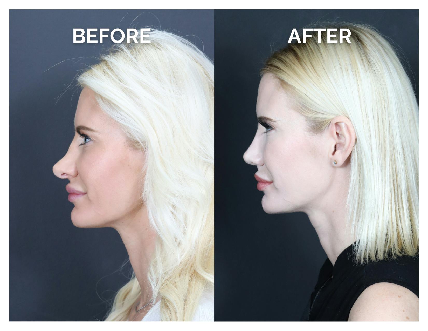 Revision Rhinoplasty Before & After Gallery - Patient 336468 - Image 4