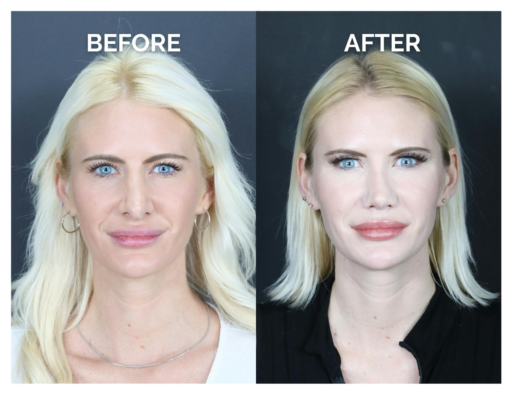 Revision Rhinoplasty Before & After Gallery - Patient 336468 - Image 1