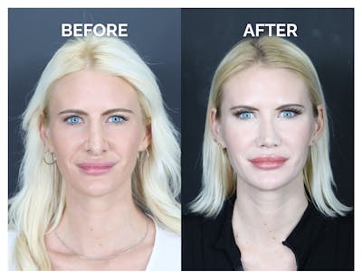 Revision Rhinoplasty Before & After Gallery - Patient 336468 - Image 1