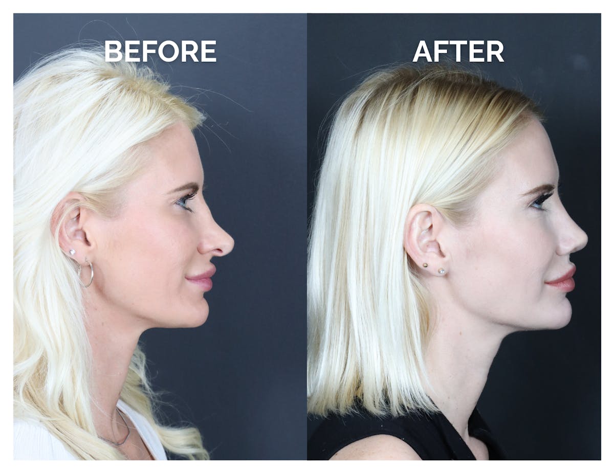 Revision Rhinoplasty Before & After Gallery - Patient 336468 - Image 2
