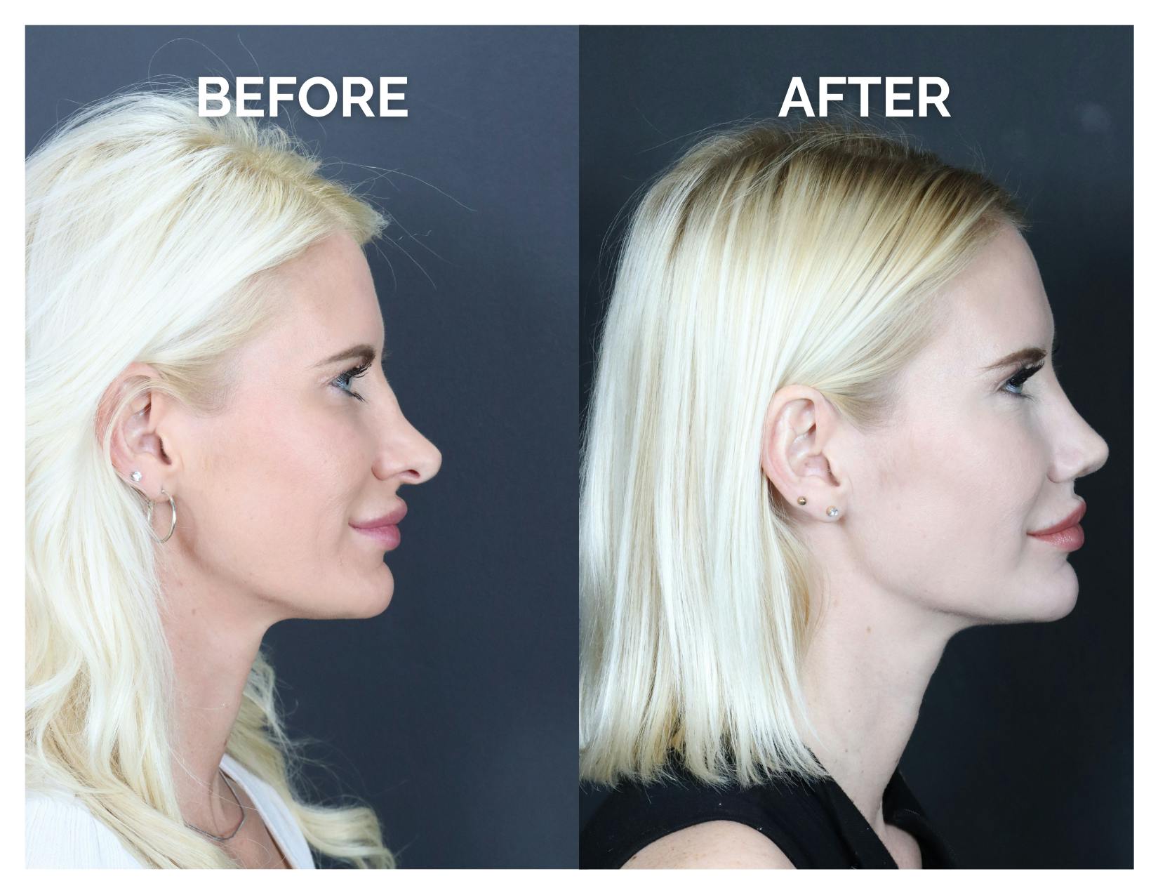 Revision Rhinoplasty Before & After Gallery - Patient 336468 - Image 2