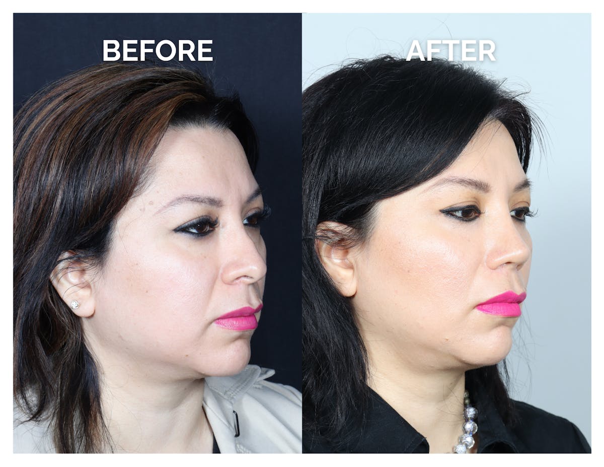 Revision Rhinoplasty Before & After Gallery - Patient 343693 - Image 1