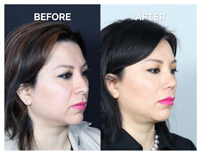 Revision Rhinoplasty Before & After Gallery - Patient 343693 - Image 1