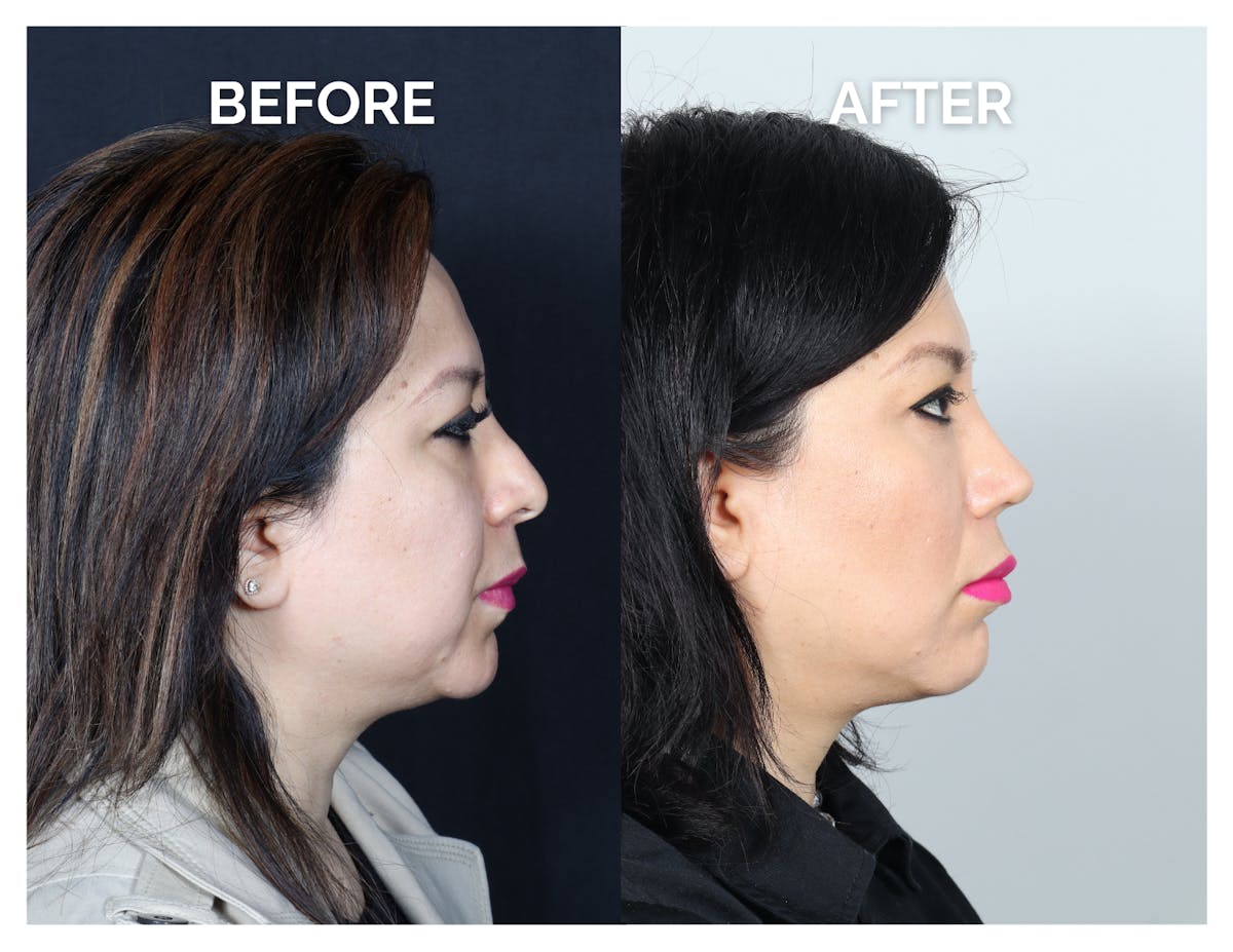 Revision Rhinoplasty Before & After Gallery - Patient 343693 - Image 2