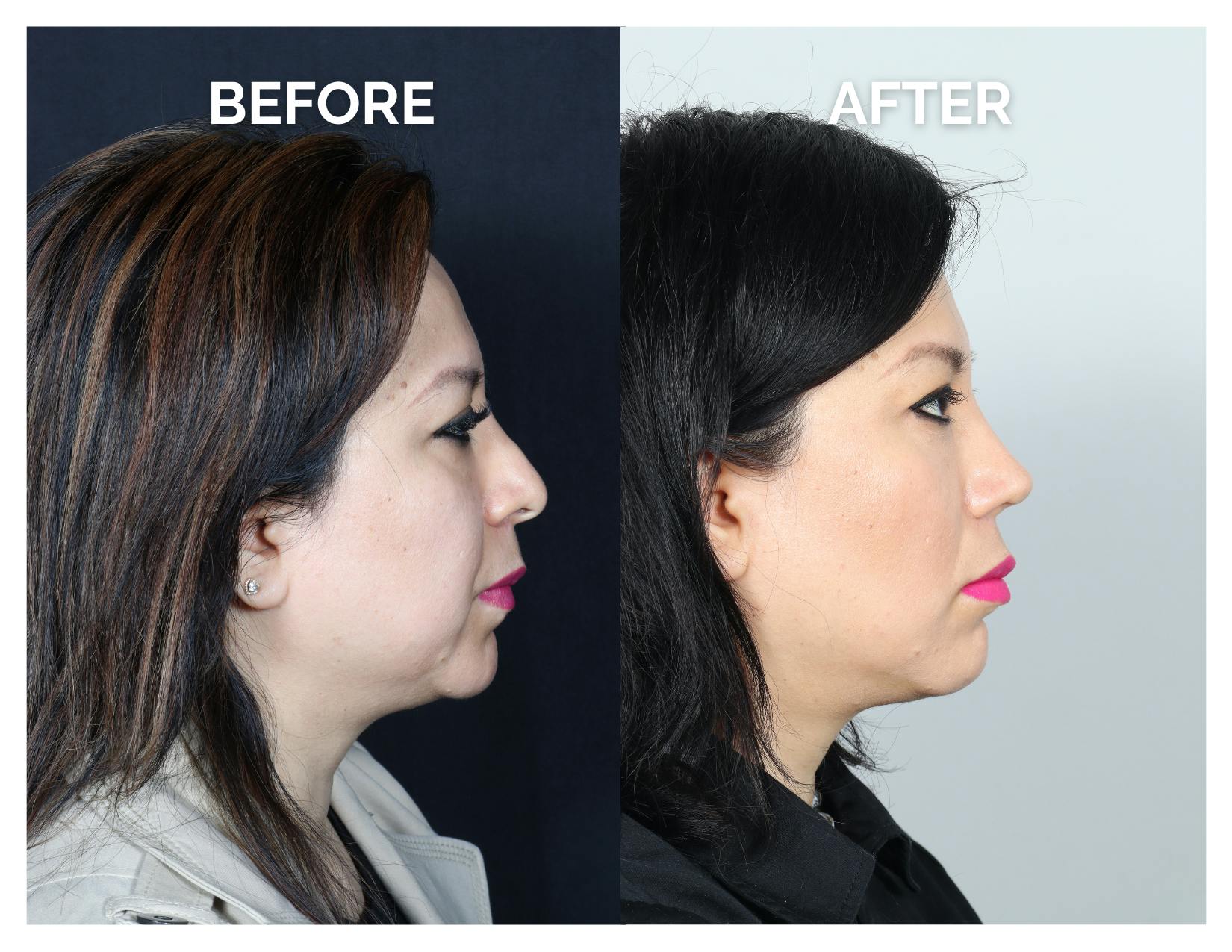 Revision Rhinoplasty Before & After Gallery - Patient 343693 - Image 2