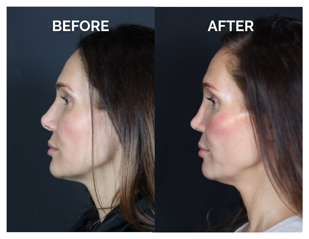 Revision Rhinoplasty Before & After Gallery - Patient 237122 - Image 6