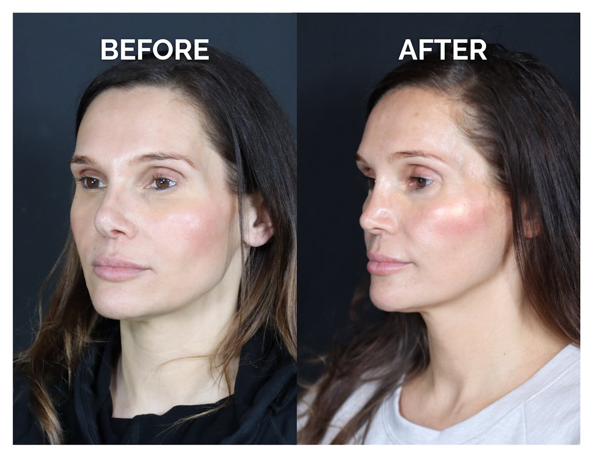 Revision Rhinoplasty Before & After Gallery - Patient 237122 - Image 4