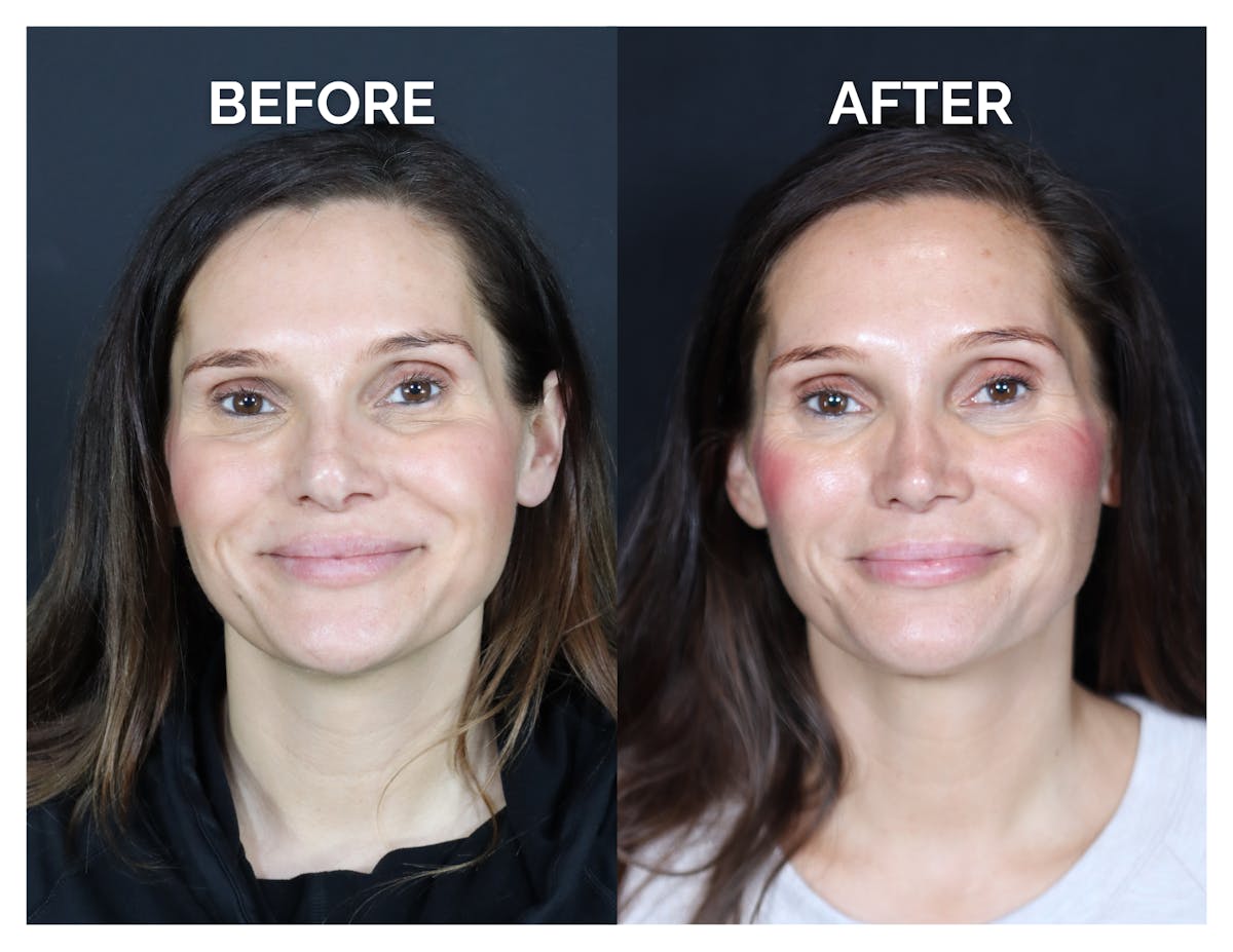 Revision Rhinoplasty Before & After Gallery - Patient 237122 - Image 1