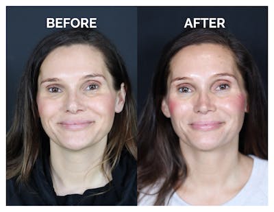 Revision Rhinoplasty Before & After Gallery - Patient 237122 - Image 1