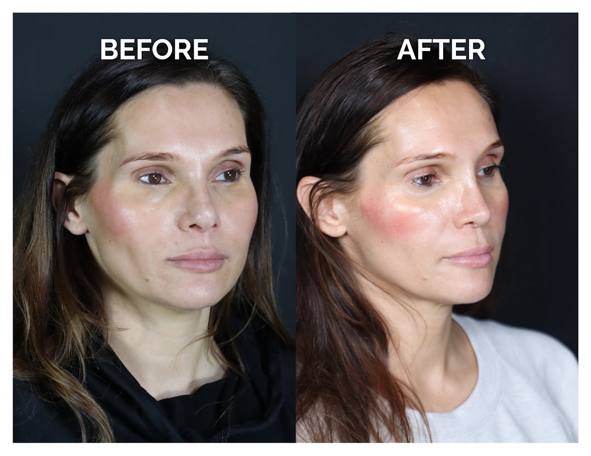 Revision Rhinoplasty Before & After Gallery - Patient 237122 - Image 5