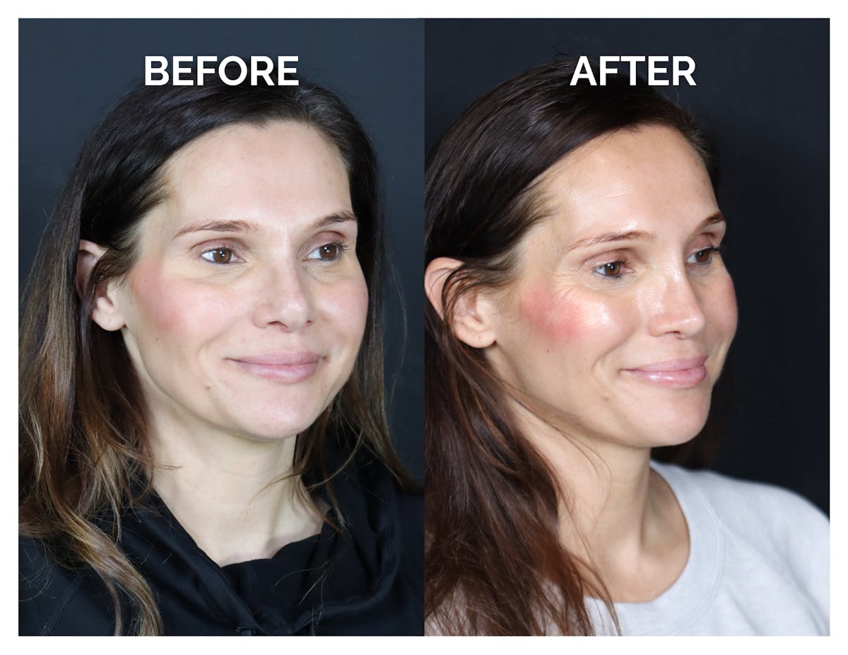 Revision Rhinoplasty Before & After Gallery - Patient 237122 - Image 2
