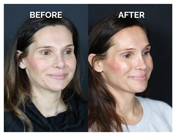 Revision Rhinoplasty Before & After Gallery - Patient 237122 - Image 1