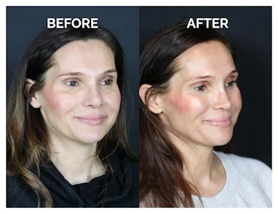 Revision Rhinoplasty Before & After Gallery - Patient 237122 - Image 1