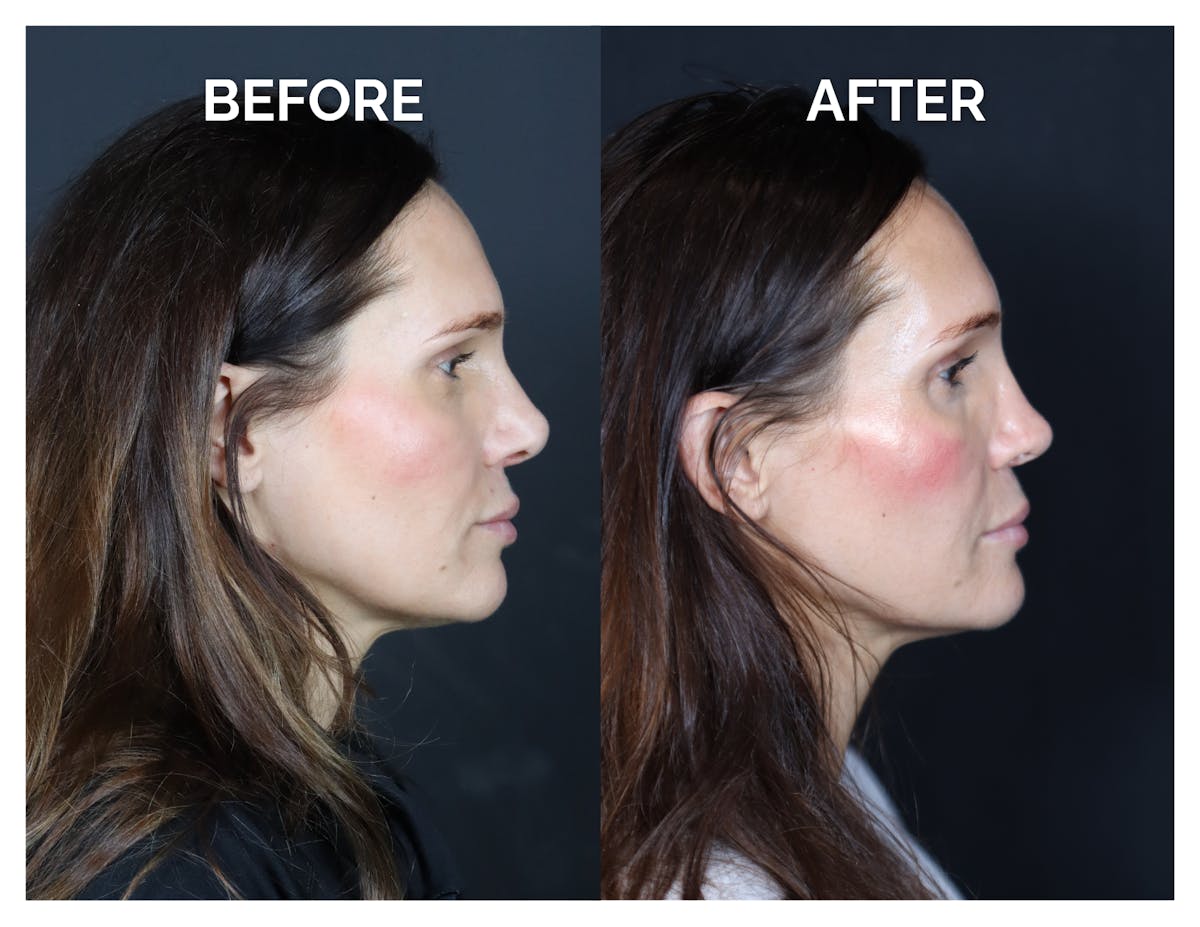 Revision Rhinoplasty Before & After Gallery - Patient 237122 - Image 3