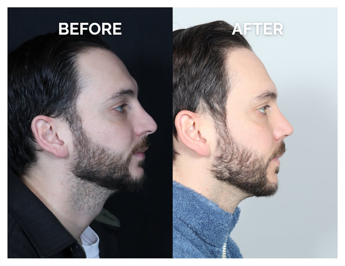 Revision Rhinoplasty Before & After Gallery - Patient 213299 - Image 3