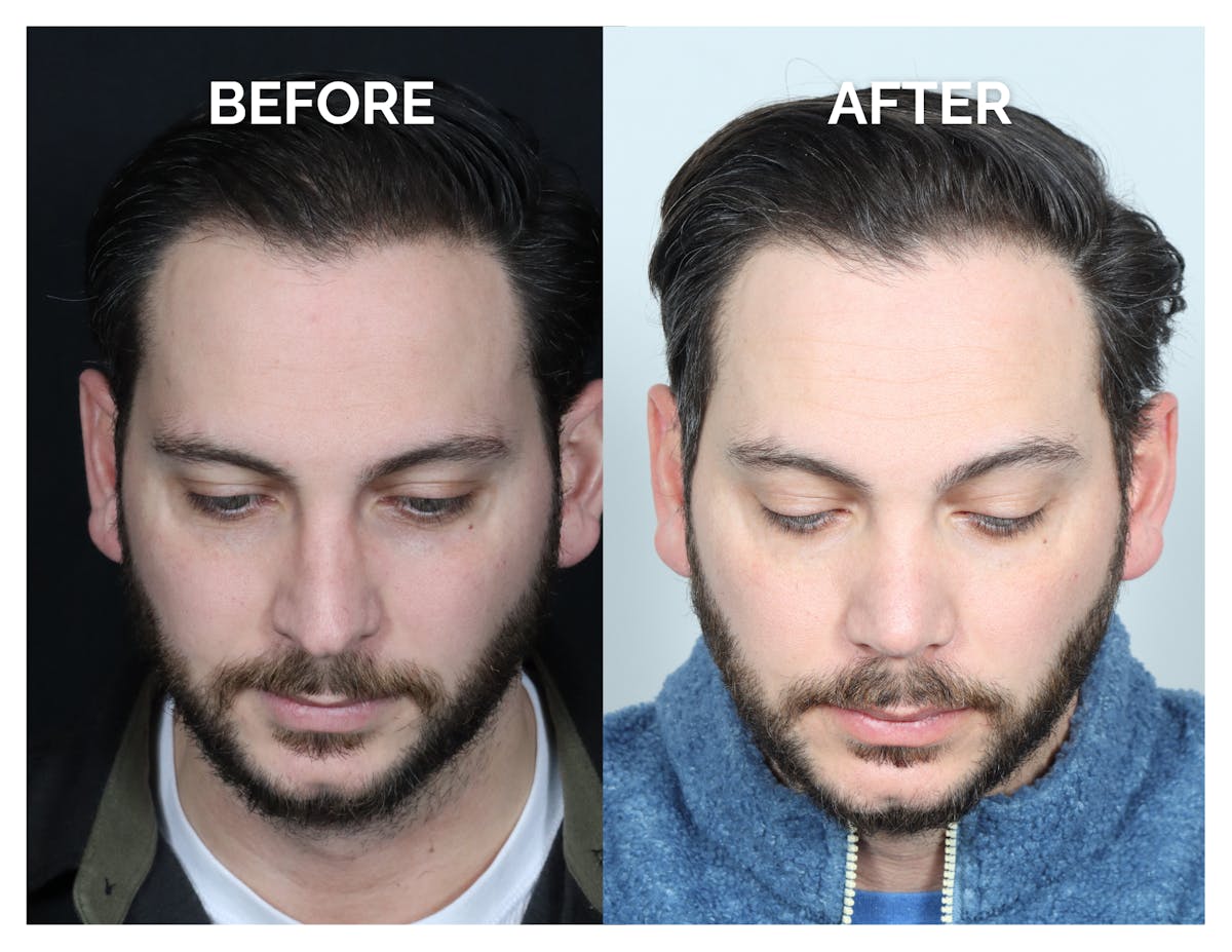 Revision Rhinoplasty Before & After Gallery - Patient 213299 - Image 2