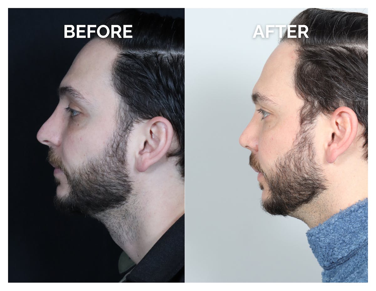 Revision Rhinoplasty Before & After Gallery - Patient 213299 - Image 7