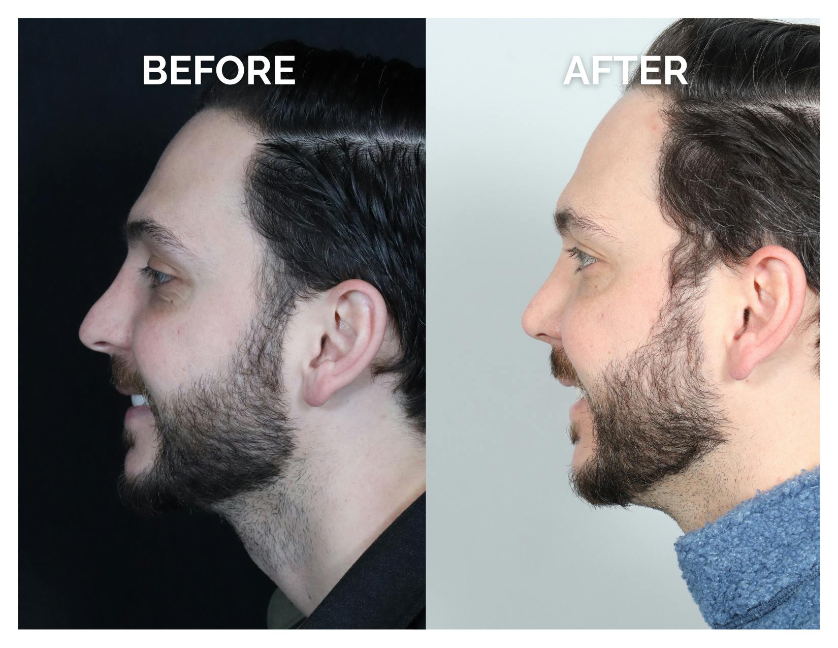 Revision Rhinoplasty Before & After Gallery - Patient 213299 - Image 6