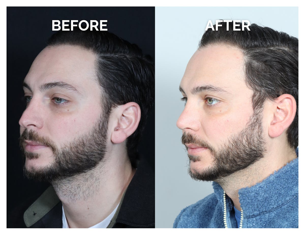 Revision Rhinoplasty Before & After Gallery - Patient 213299 - Image 5