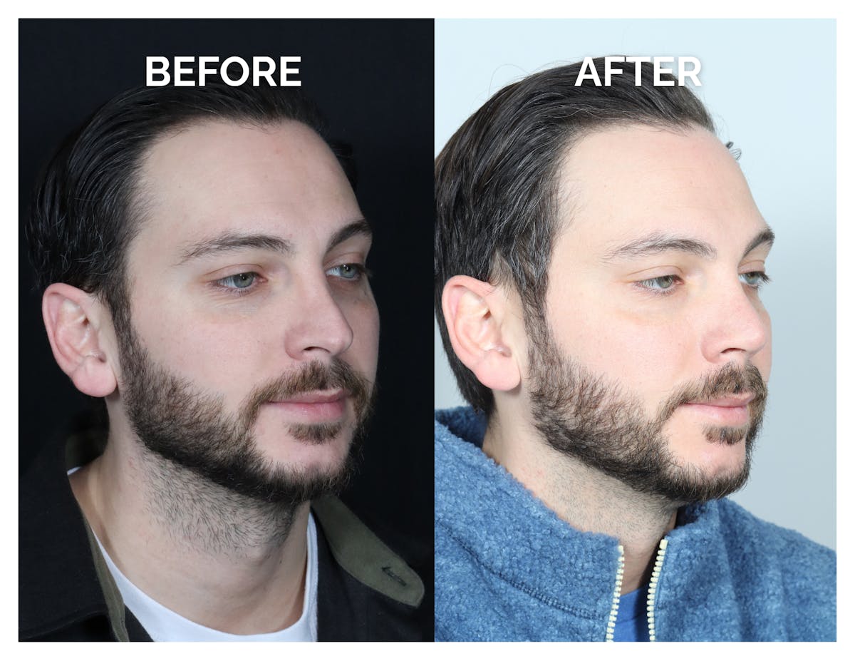 Revision Rhinoplasty Before & After Gallery - Patient 213299 - Image 4