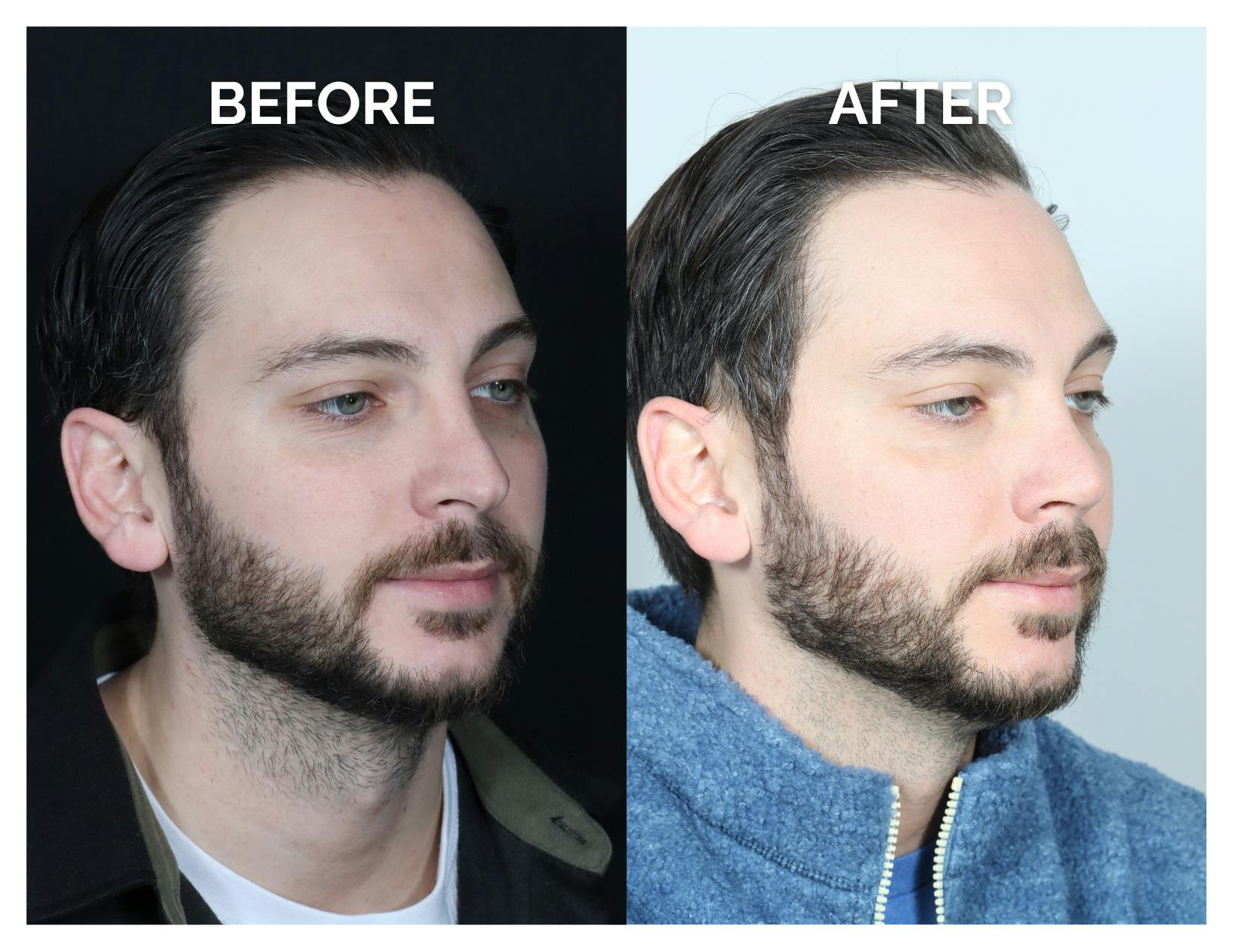Revision Rhinoplasty Before & After Gallery - Patient 213299 - Image 4