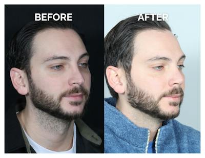 Revision Rhinoplasty Before & After Gallery - Patient 213299 - Image 1