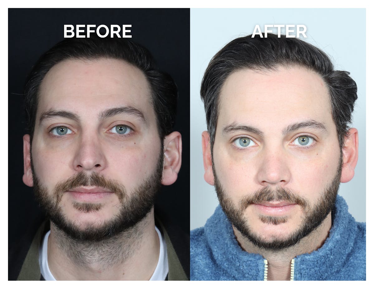 Revision Rhinoplasty Before & After Gallery - Patient 213299 - Image 1
