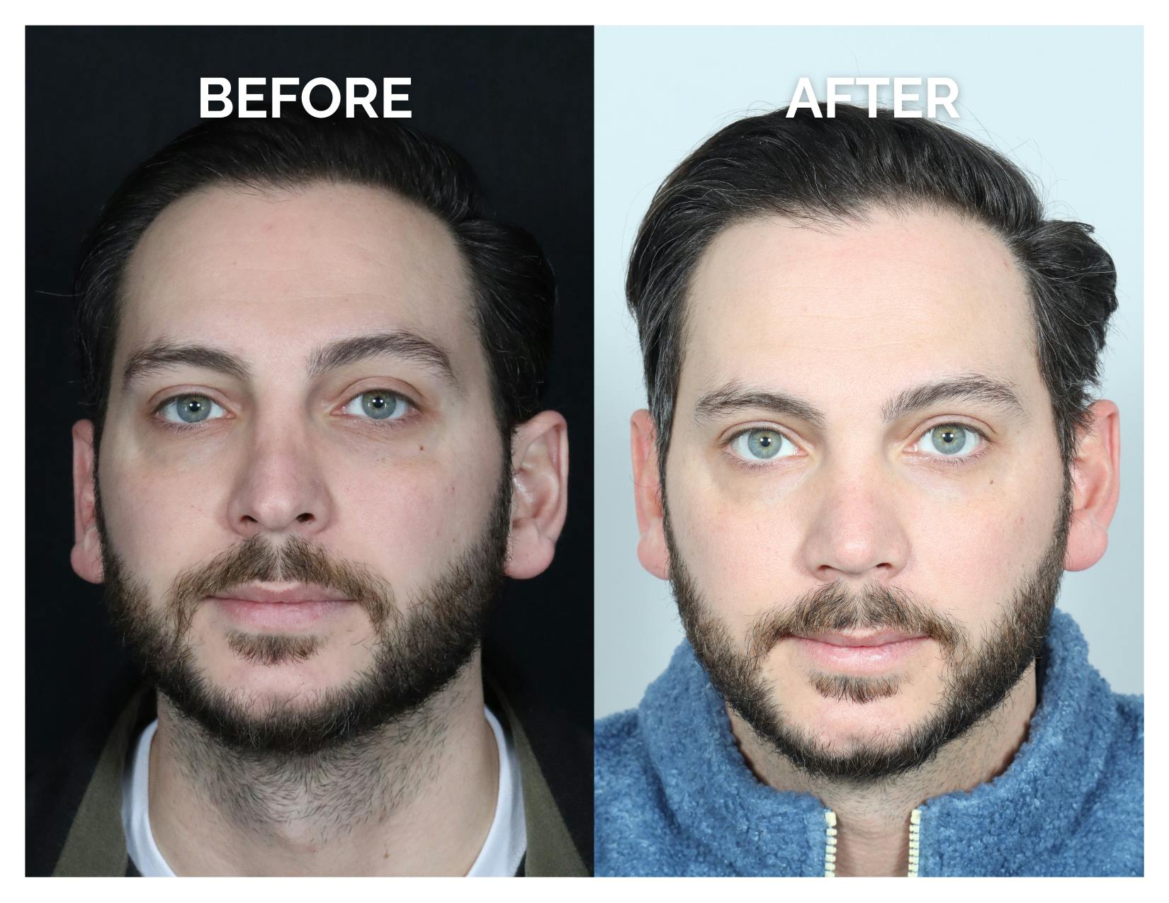 Revision Rhinoplasty Before & After Gallery - Patient 213299 - Image 1