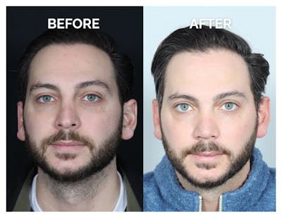Revision Rhinoplasty Before & After Gallery - Patient 213299 - Image 1