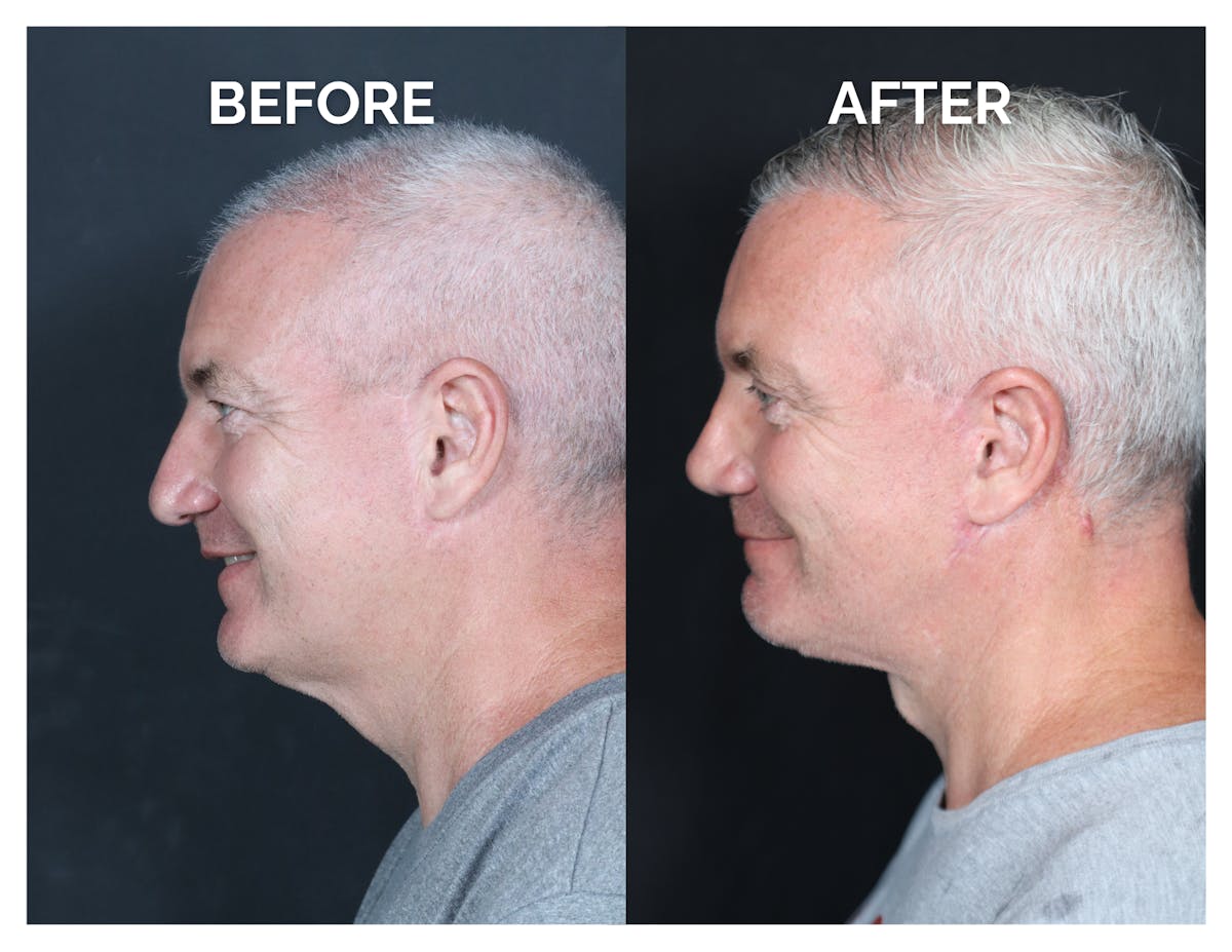 Revision Rhinoplasty Before & After Gallery - Patient 376926 - Image 2