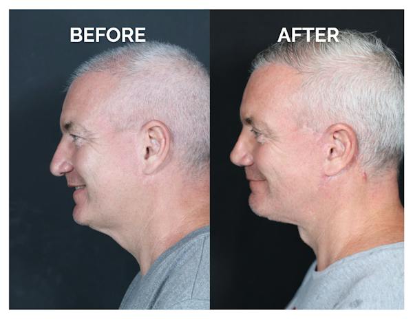 Revision Rhinoplasty Before & After Gallery - Patient 376926 - Image 1