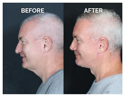 Revision Rhinoplasty Before & After Gallery - Patient 376926 - Image 1