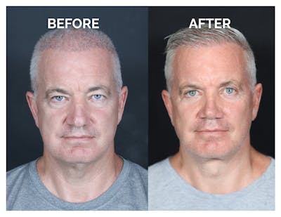 Revision Rhinoplasty Before & After Gallery - Patient 376926 - Image 1