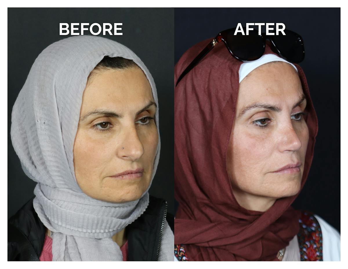 Rhinoplasty Before & After Gallery - Patient 370697 - Image 1