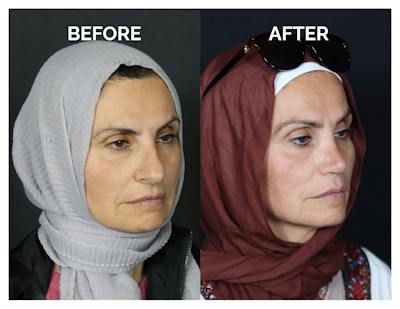 Rhinoplasty Before & After Gallery - Patient 370697 - Image 1